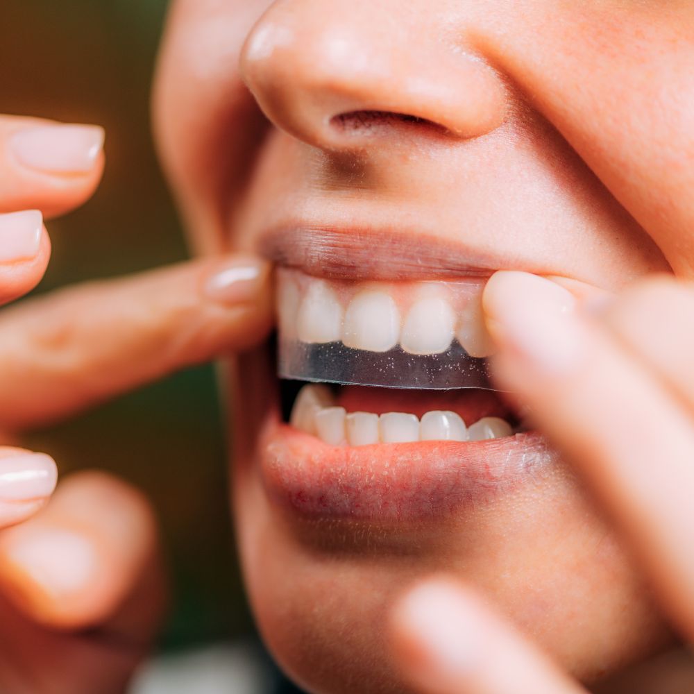 Verabschieden Sie sich von verfärbten Zähnen und begrüßen Sie ein strahlend weißes Lächeln. Entdecken Sie die Vorteile von Home Bleaching und vertrauen Sie auf unsere hochwertigen Produkte für ein perfektes Ergebnis.