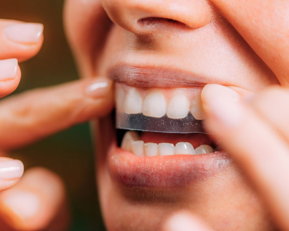 Verabschieden Sie sich von verfärbten Zähnen und begrüßen Sie ein strahlend weißes Lächeln. Entdecken Sie die Vorteile von Home Bleaching und vertrauen Sie auf unsere hochwertigen Produkte für ein perfektes Ergebnis.