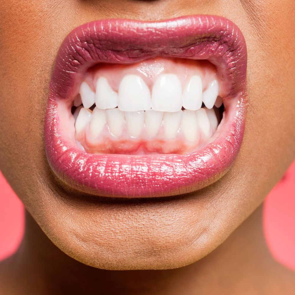 Verabschieden Sie sich von verfärbten Zähnen und begrüßen Sie ein strahlend weißes Lächeln. Entdecken Sie die Vorteile von Home Bleaching und vertrauen Sie auf unsere hochwertigen Produkte für ein perfektes Ergebnis.