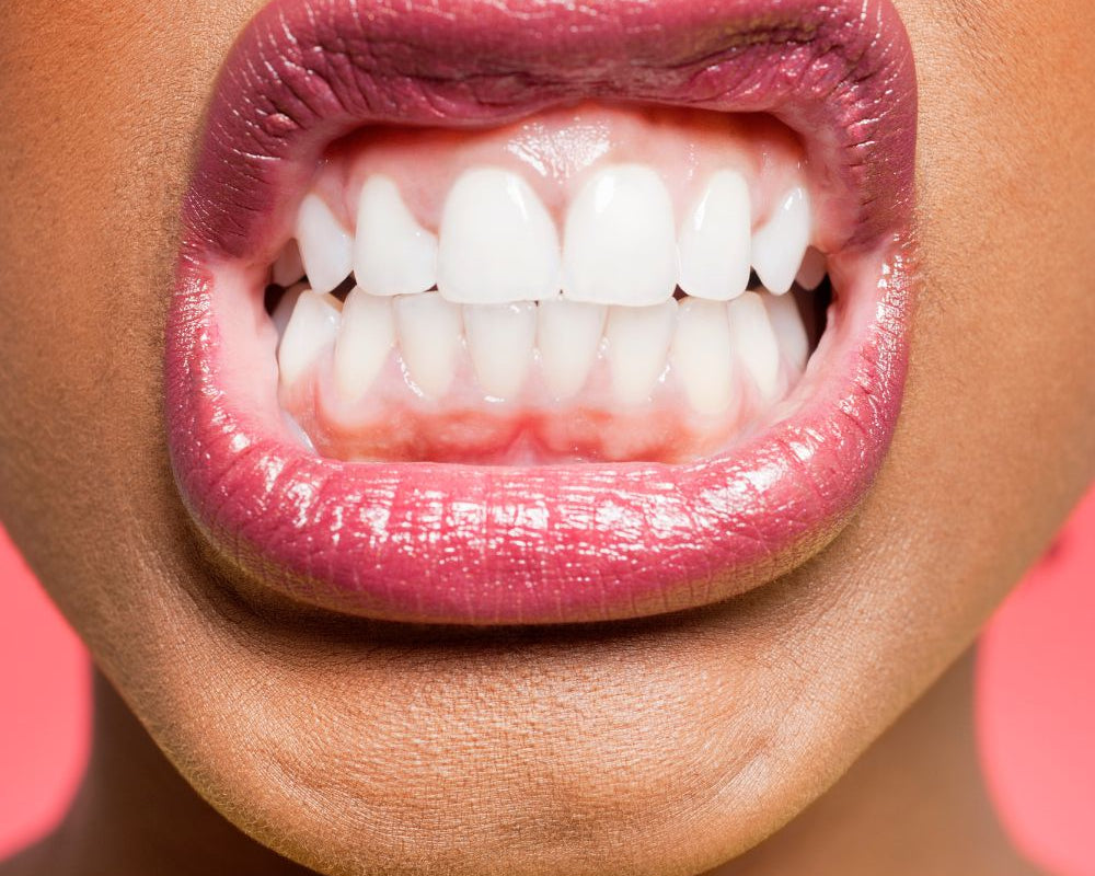 Verabschieden Sie sich von verfärbten Zähnen und begrüßen Sie ein strahlend weißes Lächeln. Entdecken Sie die Vorteile von Home Bleaching und vertrauen Sie auf unsere hochwertigen Produkte für ein perfektes Ergebnis.