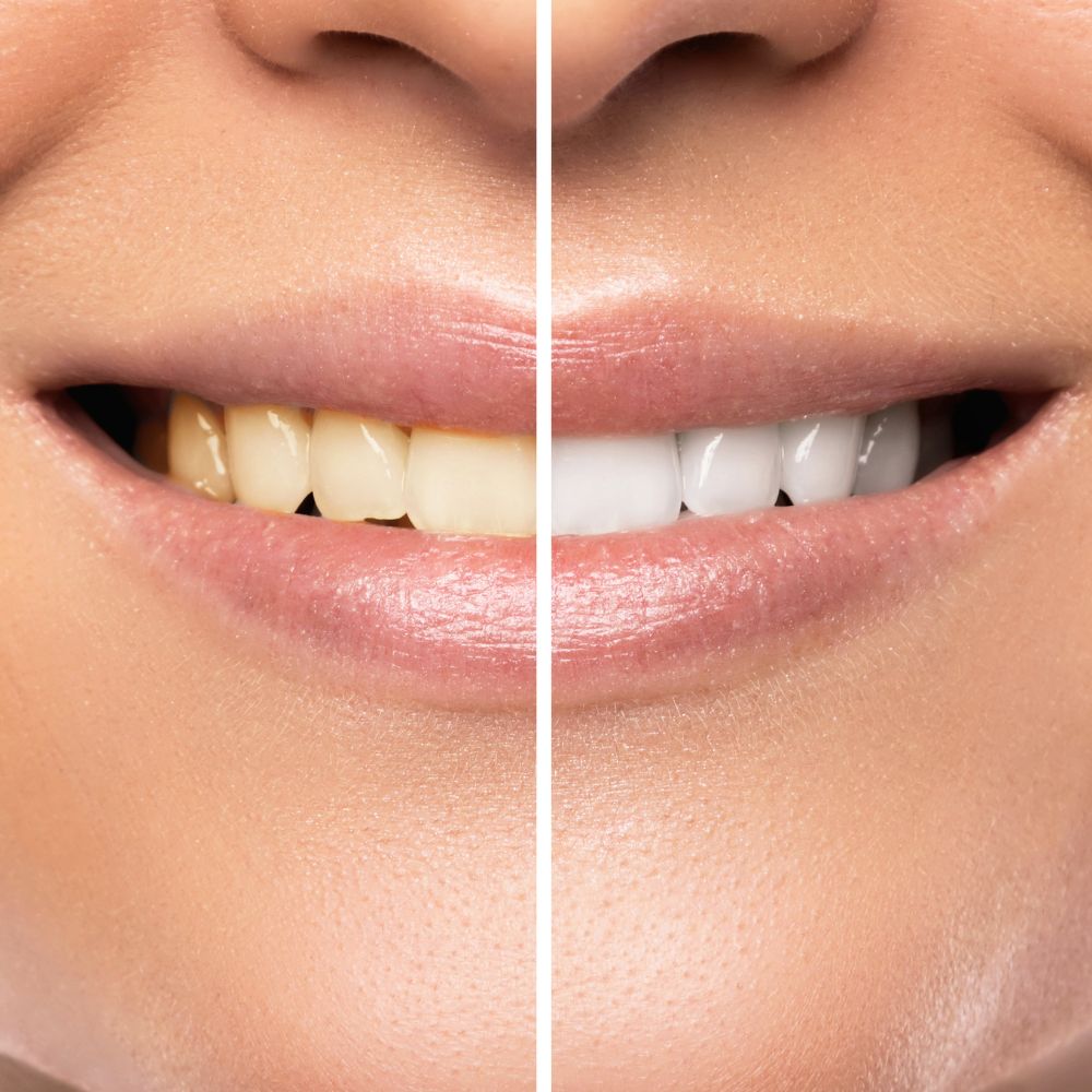 Unsere Produkte sind für ihre Wirksamkeit und Benutzerfreundlichkeit bekannt. Unser Bleaching-Gel, das auch unter dem Namen v34 color corrector bekannt ist, wird Sie mit seinen Ergebnissen beeindrucken.
