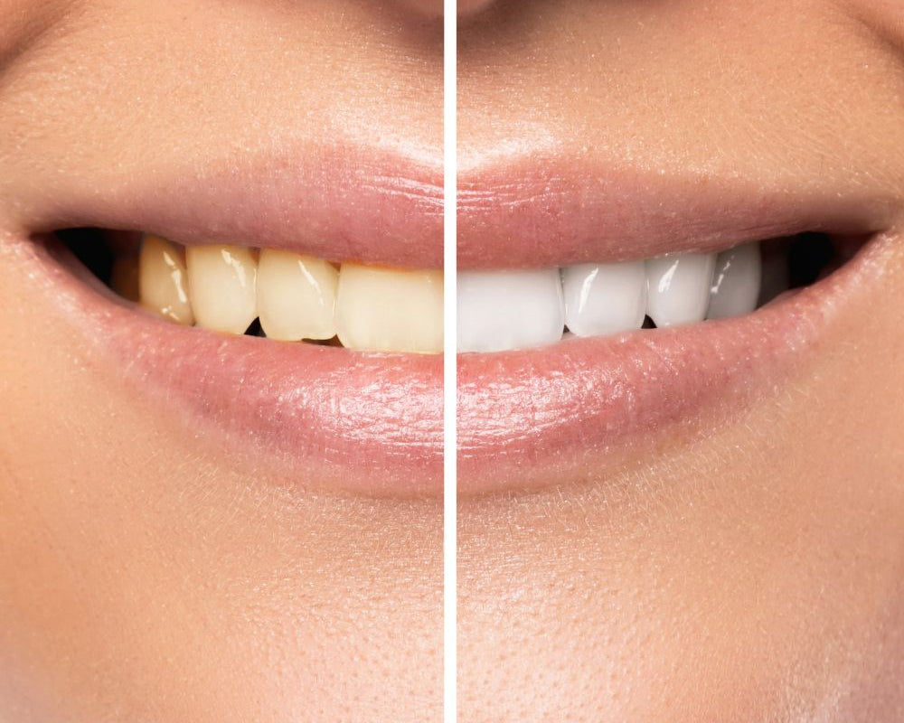 Unsere Produkte sind für ihre Wirksamkeit und Benutzerfreundlichkeit bekannt. Unser Bleaching-Gel, das auch unter dem Namen v34 color corrector bekannt ist, wird Sie mit seinen Ergebnissen beeindrucken.