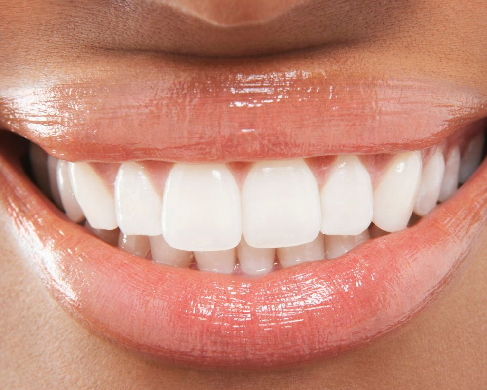 Verabschieden Sie sich von verfärbten Zähnen und begrüßen Sie ein strahlend weißes Lächeln. Entdecken Sie die Vorteile von Home Bleaching und vertrauen Sie auf unsere hochwertigen Produkte für ein perfektes Ergebnis.