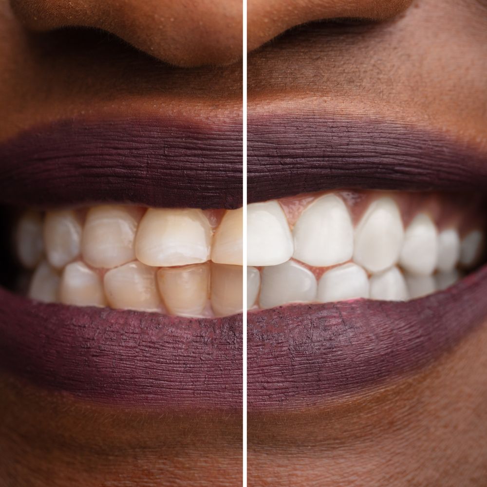 Unsere Produkte sind für ihre Wirksamkeit und Benutzerfreundlichkeit bekannt. Unser Bleaching-Gel, das auch unter dem Namen v34 color corrector bekannt ist, wird Sie mit seinen Ergebnissen beeindrucken.