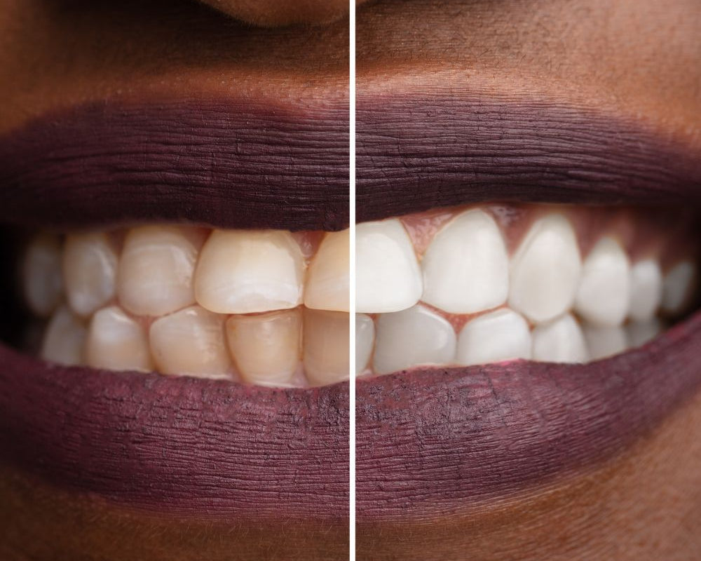Unsere Produkte sind für ihre Wirksamkeit und Benutzerfreundlichkeit bekannt. Unser Bleaching-Gel, das auch unter dem Namen v34 color corrector bekannt ist, wird Sie mit seinen Ergebnissen beeindrucken.