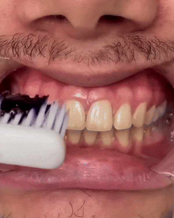 SUGARSMILE V34 COLOUR CORRECTOR - Whitening for teeth – Sugarsmile.de